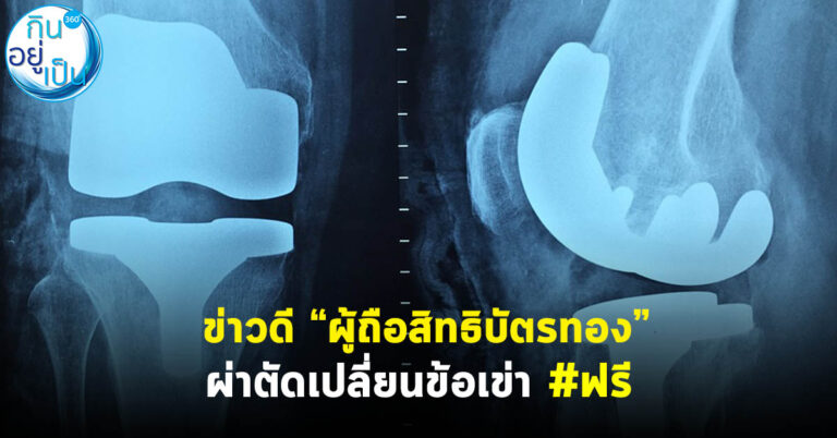 ข่าวดี “ผู้ถือสิทธิบัตรทอง” ผ่าตัดเปลี่ยนข้อเข่า #ฟรี